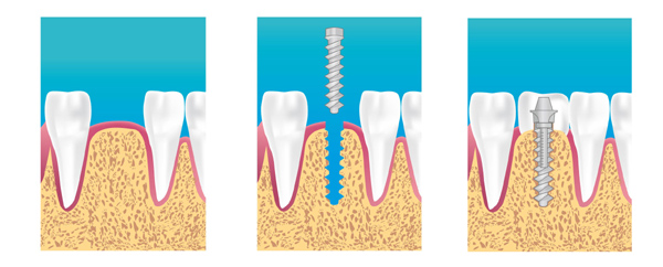 implant trappes